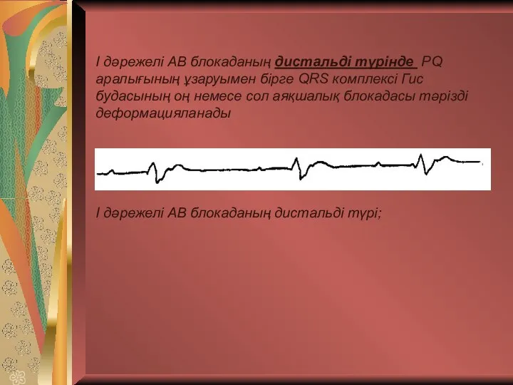 І дәрежелі АВ блокаданың дистальді түрінде PQ аралығының ұзаруымен бірге