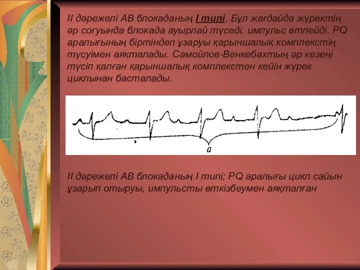 ІІ дәрежелі АВ блокаданың І типі. Бұл жағдайда жүректің әр