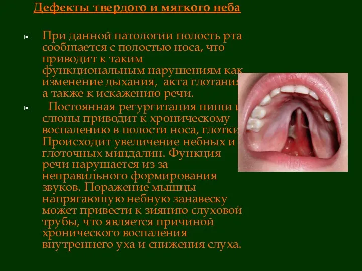 Дефекты твердого и мягкого неба При данной патологии полость рта