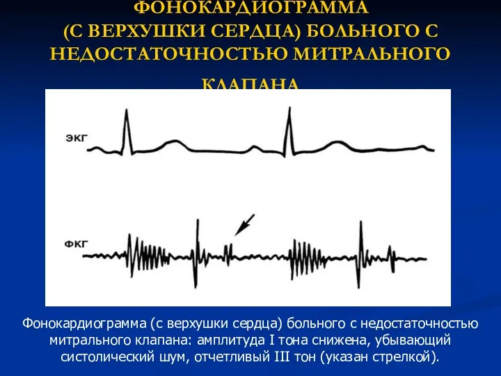 ФОНОКАРДИОГРАММА (С ВЕРХУШКИ СЕРДЦА) БОЛЬНОГО С НЕДОСТАТОЧНОСТЬЮ МИТРАЛЬНОГО КЛАПАНА Фонокардиограмма