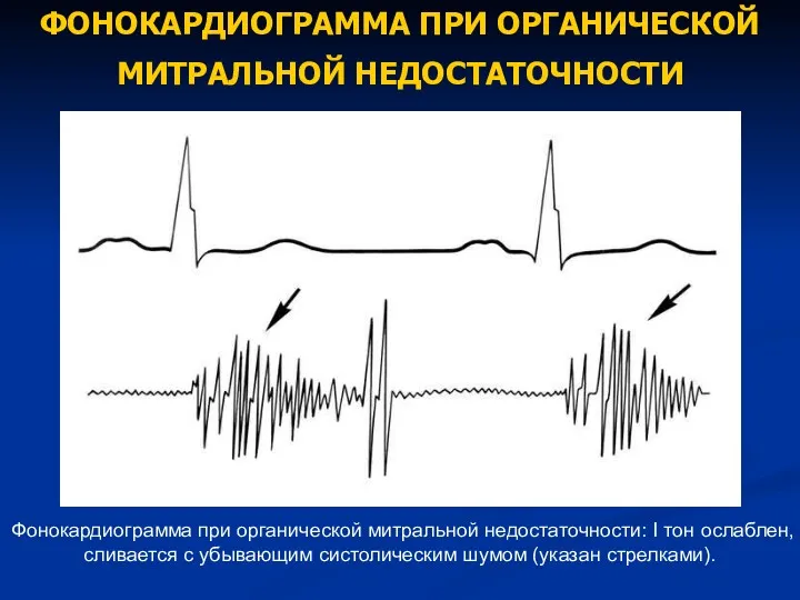 ФОНОКАРДИОГРАММА ПРИ ОРГАНИЧЕСКОЙ МИТРАЛЬНОЙ НЕДОСТАТОЧНОСТИ Фонокардиограмма при органической митральной недостаточности: