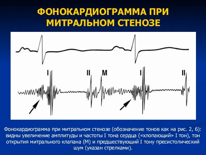 ФОНОКАРДИОГРАММА ПРИ МИТРАЛЬНОМ СТЕНОЗЕ Фонокардиограмма при митральном стенозе (обозначение тонов