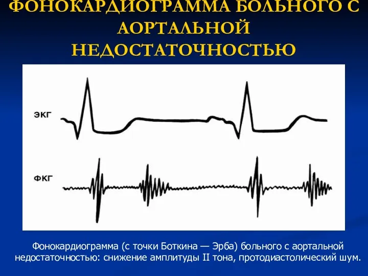 ФОНОКАРДИОГРАММА БОЛЬНОГО С АОРТАЛЬНОЙ НЕДОСТАТОЧНОСТЬЮ Фонокардиограмма (с точки Боткина —