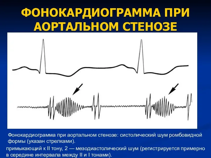 ФОНОКАРДИОГРАММА ПРИ АОРТАЛЬНОМ СТЕНОЗЕ Фонокардиограмма при аортальном стенозе: систолический шум