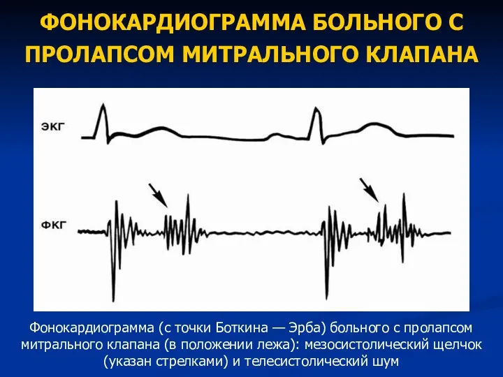 ФОНОКАРДИОГРАММА БОЛЬНОГО С ПРОЛАПСОМ МИТРАЛЬНОГО КЛАПАНА Фонокардиограмма (с точки Боткина