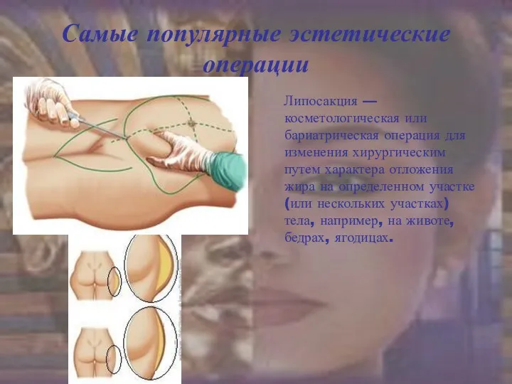 Самые популярные эстетические операции Липосакция — косметологическая или бариатрическая операция