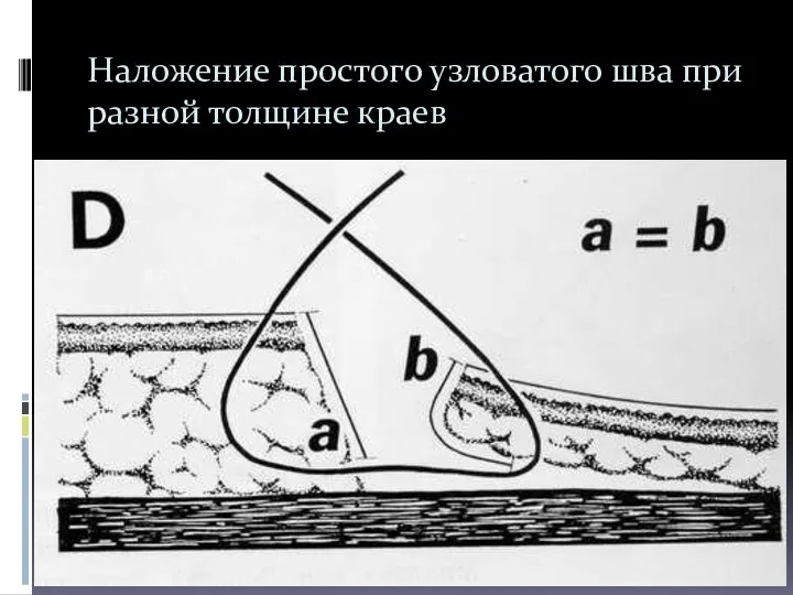 Наложение простого узловатого шва при разной толщине краев