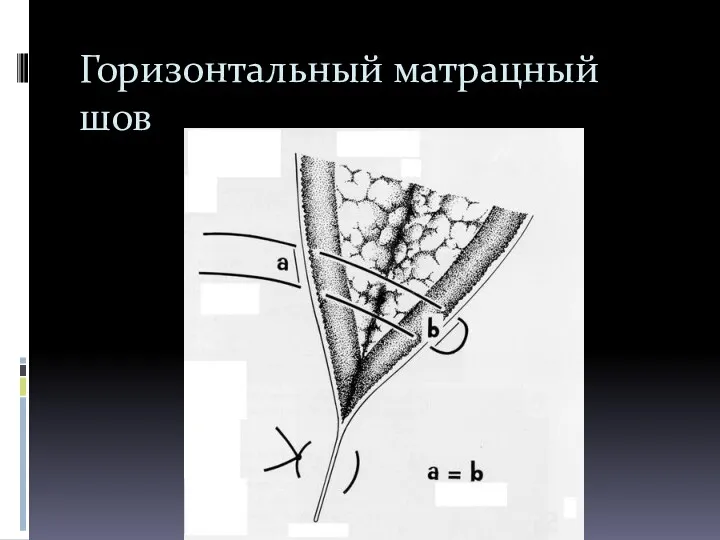 Горизонтальный матрацный шов