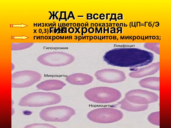 ЖДА – всегда гипохромная низкий цветовой показатель (ЦП=Гб/Э х 0,3) гипохромия эритроцитов, микроцитоз;