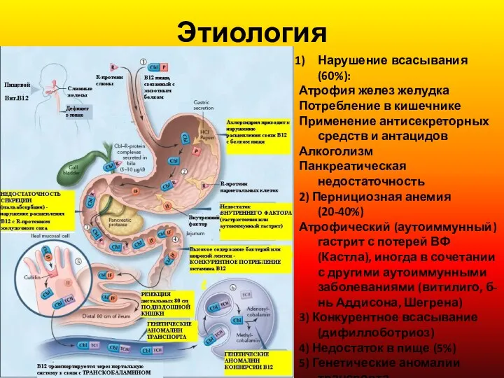 Этиология Нарушение всасывания (60%): Атрофия желез желудка Потребление в кишечнике