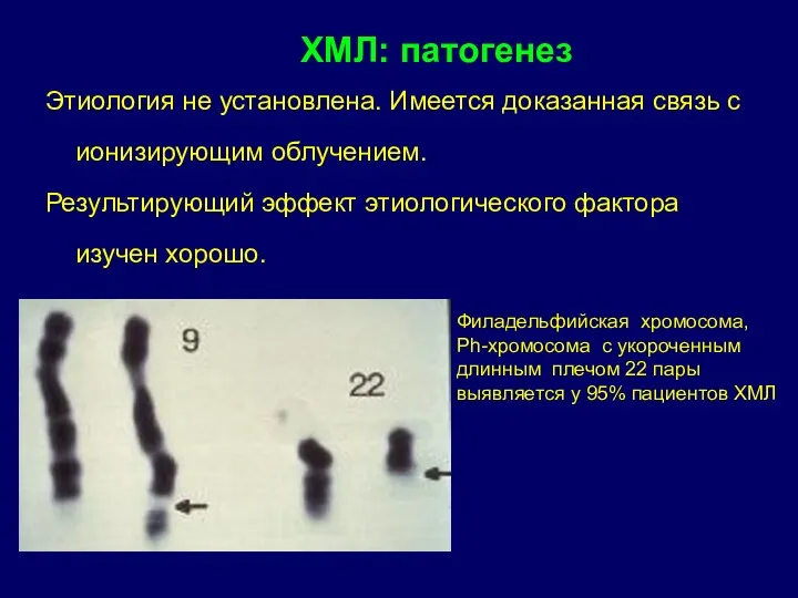 Этиология не установлена. Имеется доказанная связь с ионизирующим облучением. Результирующий