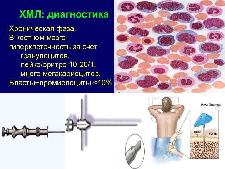 Хроническая фаза. В костном мозге: гиперклеточность за счет гранулоцитов, лейко/эритро 10-20/1, много мегакариоцитов. Бласты+промиелоциты ХМЛ: диагностика