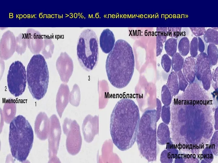 В крови: бласты >30%, м.б. «лейкемический провал»