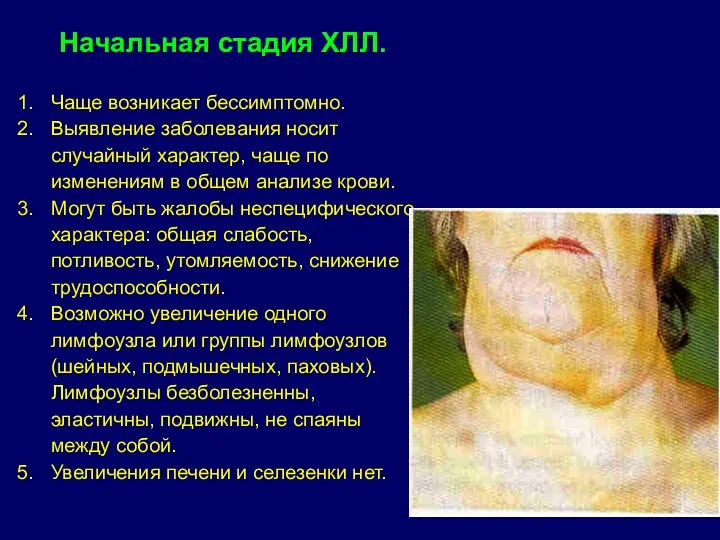 Начальная стадия ХЛЛ. Чаще возникает бессимптомно. Выявление заболевания носит случайный