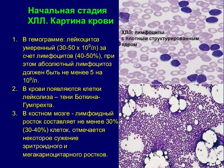 Начальная стадия ХЛЛ. Картина крови В гемограмме: лейкоцитоз умеренный (30-50