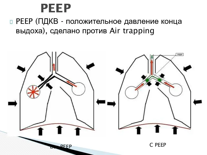 PEEP (ПДКВ - положительное давление конца выдоха), сделано против Air trapping PEEP Без PEEP C PEEP