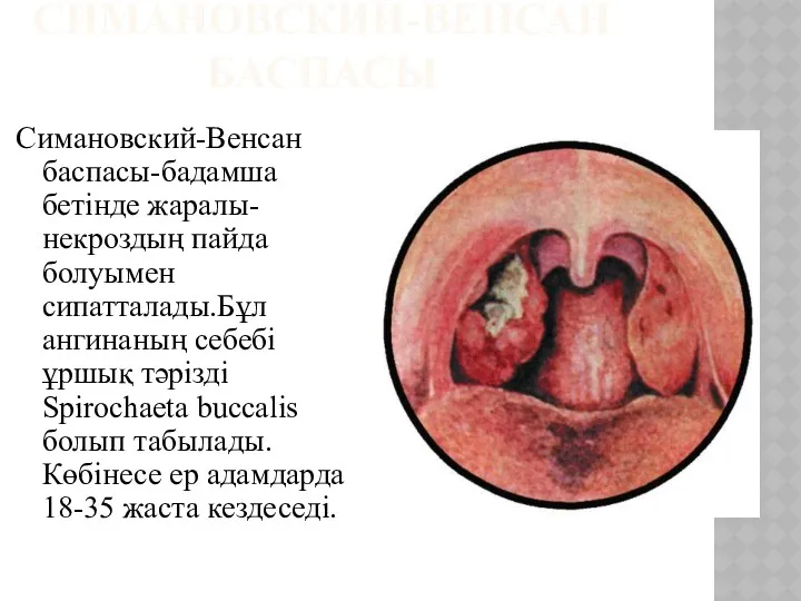 СИМАНОВСКИЙ-ВЕНСАН БАСПАСЫ Симановский-Венсан баспасы-бадамша бетінде жаралы-некроздың пайда болуымен сипатталады.Бұл ангинаның себебі ұршық тәрізді