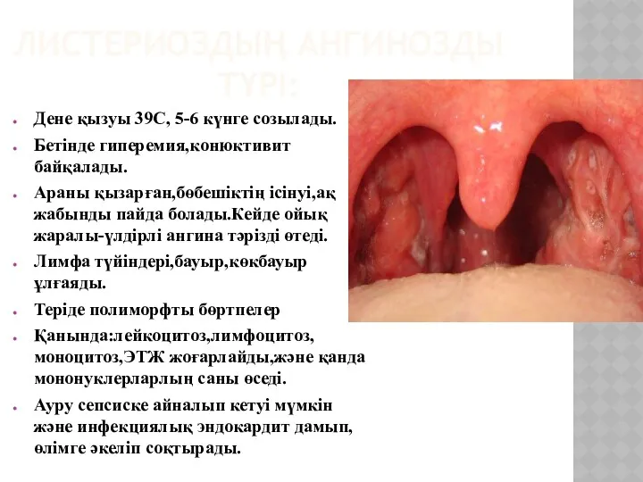 ЛИСТЕРИОЗДЫҢ АНГИНОЗДЫ ТҮРІ: Дене қызуы 39С, 5-6 күнге созылады. Бетінде