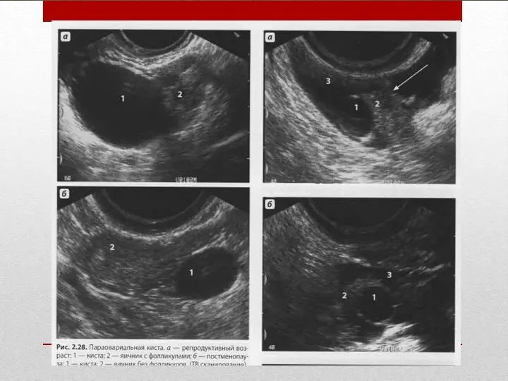 Основным и практическим единственным УЗ признаком параовариальных кист является визуализация