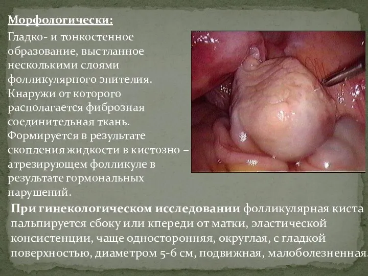 Морфологически: Гладко- и тонкостенное образование, выстланное несколькими слоями фолликулярного эпителия.