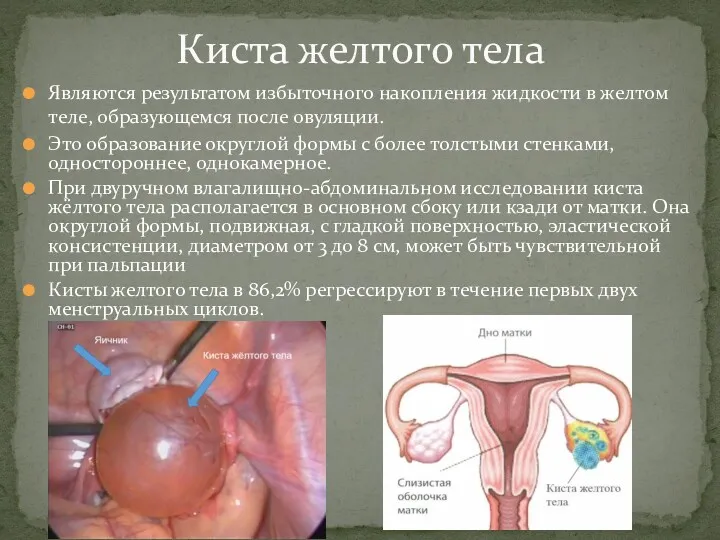 Являются результатом избыточного накопления жидкости в желтом теле, образующемся после