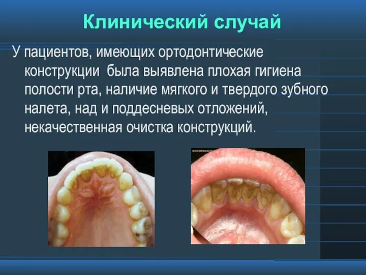 Клинический случай У пациентов, имеющих ортодонтические конструкции была выявлена плохая