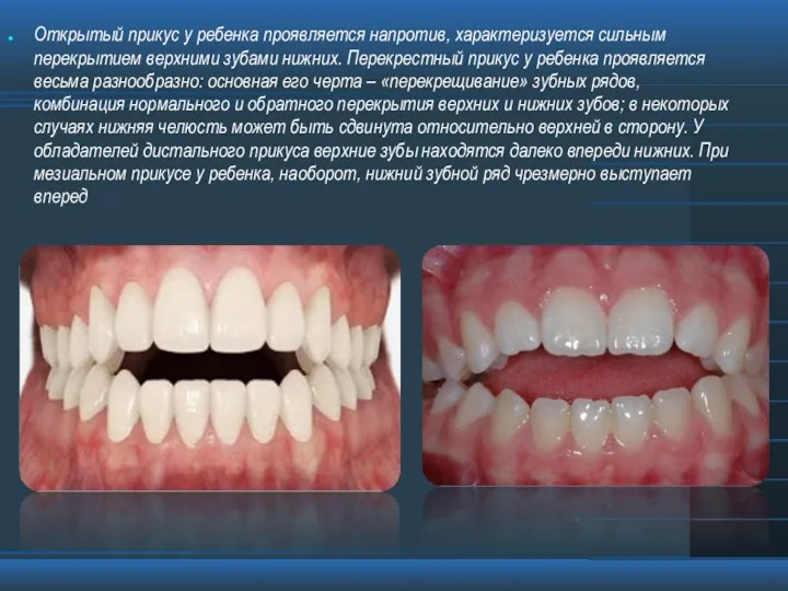 Открытый прикус у ребенка проявляется напротив, характеризуется сильным перекрытием верхними