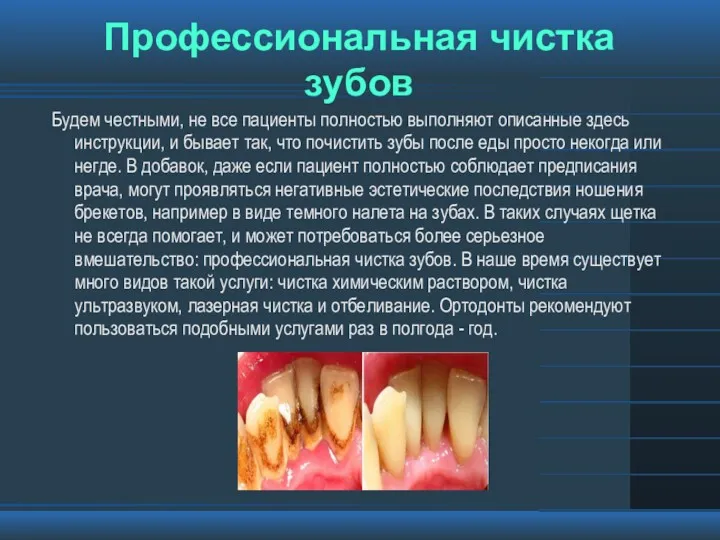 Профессиональная чистка зубов Будем честными, не все пациенты полностью выполняют