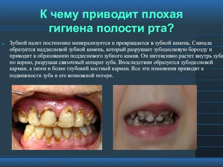 К чему приводит плохая гигиена полости рта? Зубной налет постепенно