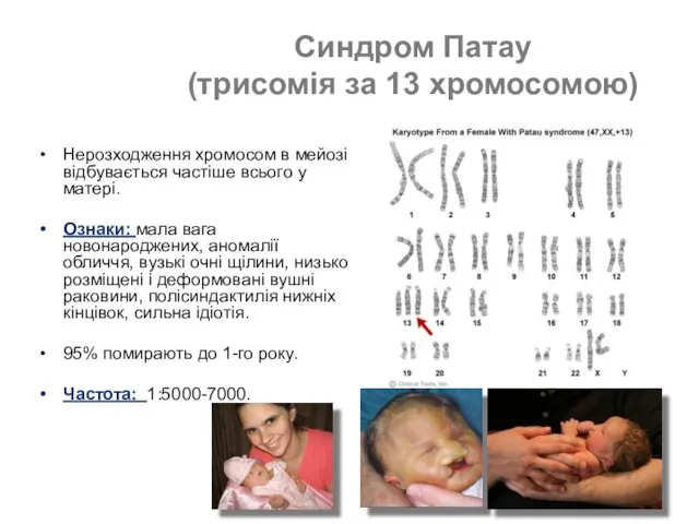 Синдром Патау (трисомія за 13 хромосомою) Нерозходження хромосом в мейозі