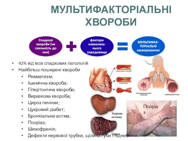 МУЛЬТИФАКТОРІАЛЬНІ ХВОРОБИ 92% від всіх спадкових патологій Найбільш поширені хвороби