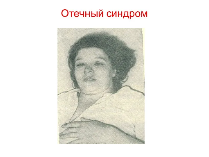 Отечный синдром