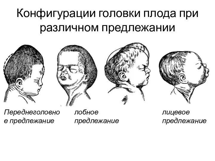 Конфигурации головки плода при различном предлежании Переднеголовное предлежание лобное предлежание лицевое предлежание