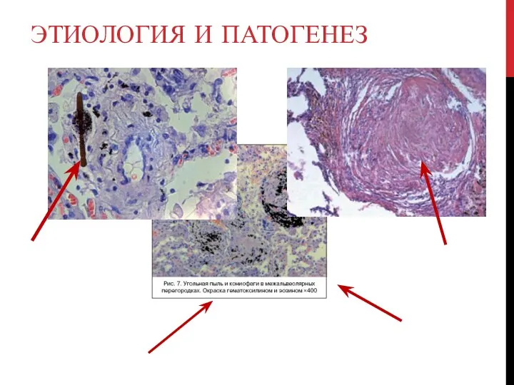 ЭТИОЛОГИЯ И ПАТОГЕНЕЗ