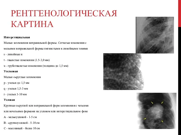 РЕНТГЕНОЛОГИЧЕСКАЯ КАРТИНА Интерстициальная Малые затемнения неправильной формы. Сетчатые изменения с мелкими неправильной формы