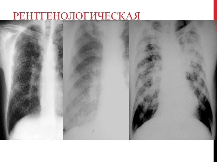 РЕНТГЕНОЛОГИЧЕСКАЯ КЛАССИФИКАЦИЯ I стадия-интерстициальные изменения (ячеистый и линейный легочный рисунок), или мелкоузелковый диффузный