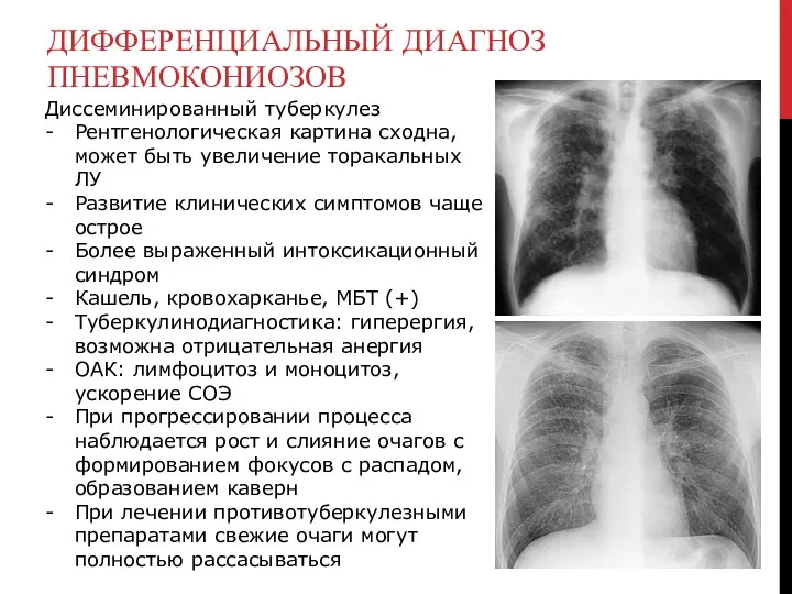 ДИФФЕРЕНЦИАЛЬНЫЙ ДИАГНОЗ ПНЕВМОКОНИОЗОВ Диссеминированный туберкулез Рентгенологическая картина сходна, может быть увеличение торакальных ЛУ