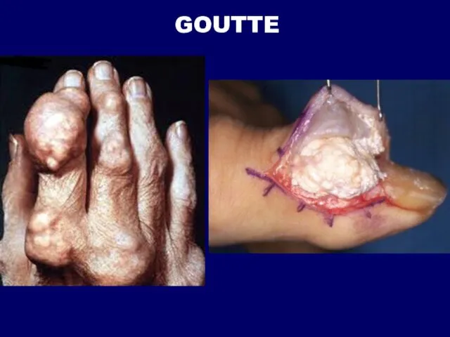 GOUTTE