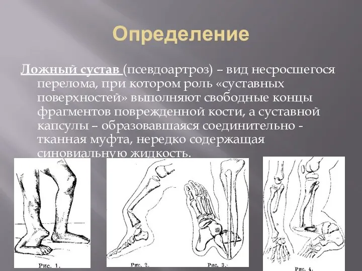 Определение Ложный сустав (псевдоартроз) – вид несросшегося перелома, при котором