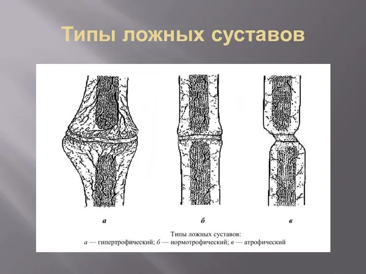 Типы ложных суставов