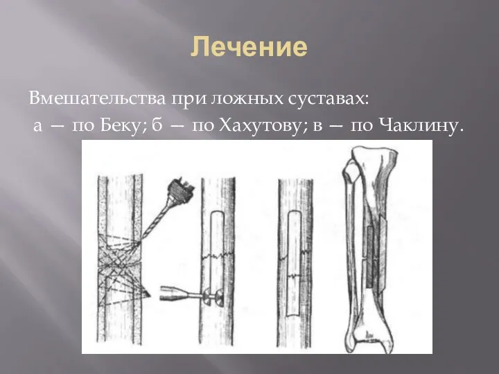 Лечение Вмешательства при ложных суставах: а — по Беку; б