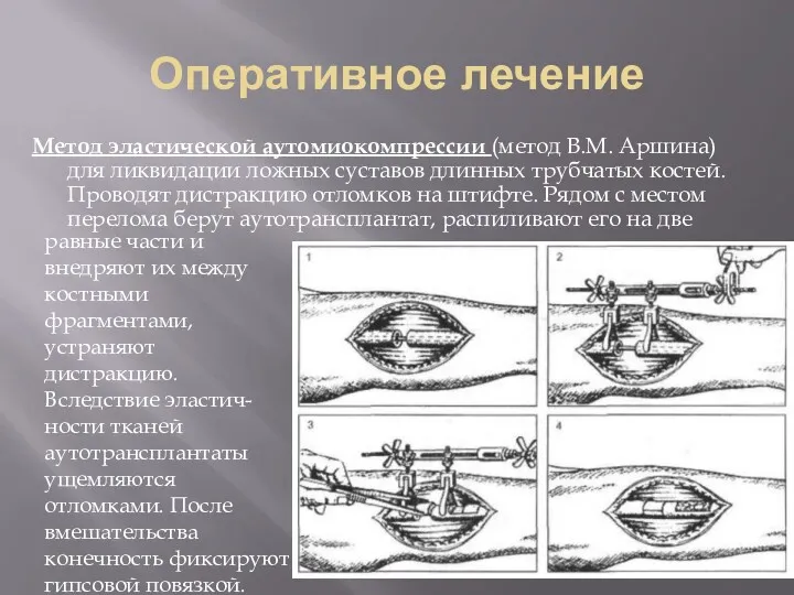 Оперативное лечение Метод эластической аутомиокомпрессии (метод В.М. Аршина) для ликвидации