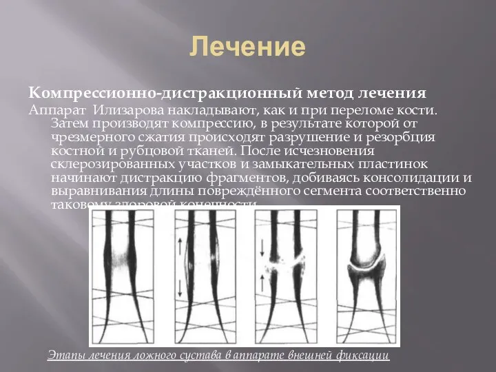 Лечение Компрессионно-дистракционный метод лечения Аппарат Илизарова накладывают, как и при