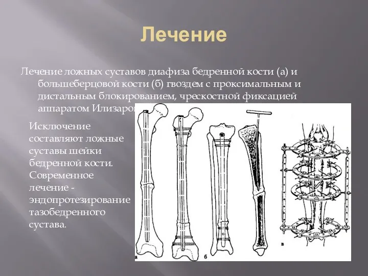 Лечение Лечение ложных суставов диафиза бедренной кости (а) и большеберцовой