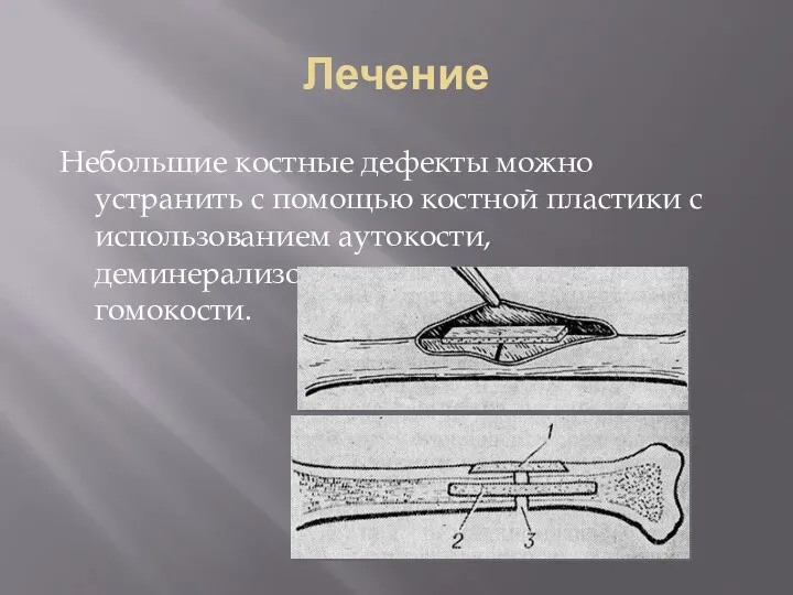 Лечение Небольшие костные дефекты можно устранить с помощью костной пластики с использованием аутокости, деминерализованного остеоматрикса, гомокости.