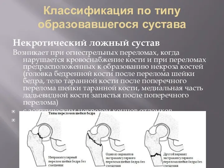 Классификация по типу образовавшегося сустава Некротический ложный сустав Возникает при