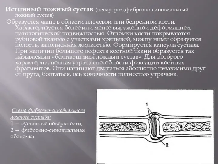 Истинный ложный сустав (неоартроз; фиброзно-синовиальный ложный сустав) Образуется чаще в