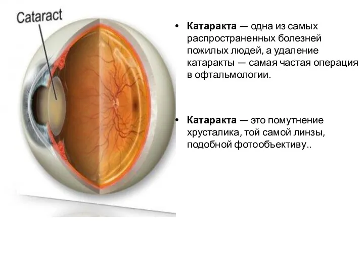 Катаракта — одна из самых распространенных болезней пожилых людей, а