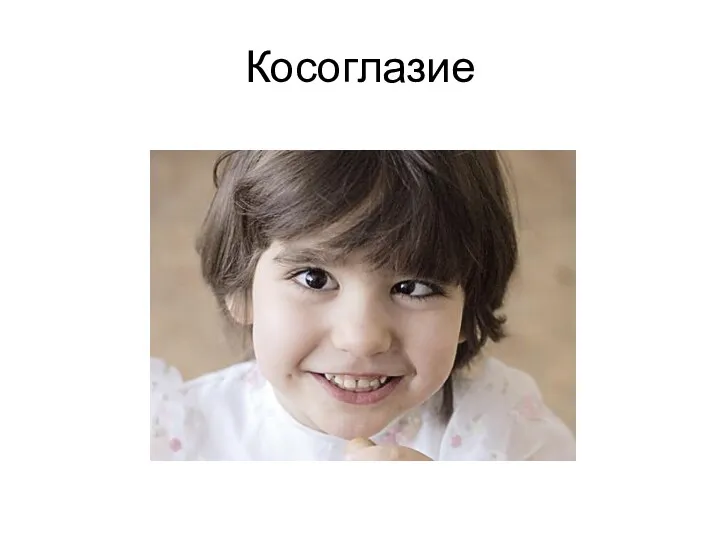 Косоглазие