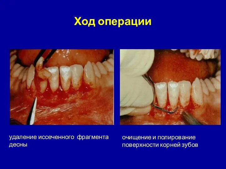 удаление иссеченного фрагмента десны очищение и полирование поверхности корней зубов Ход операции
